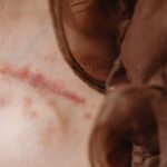 Detailed close-up of human skin revealing a surgical scar, skin texture, and fabric detail.